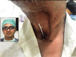 गले के कैंसर में मात्र 50 रुपये की इस डिवाइस को लगाकर बोलेने लगेंगे मरीज